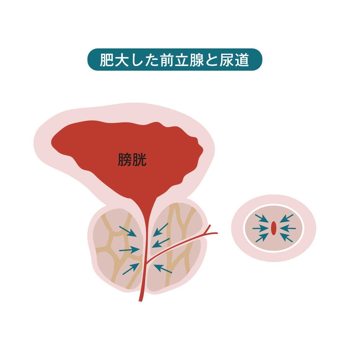 イメージ：肥大した前立腺と尿道