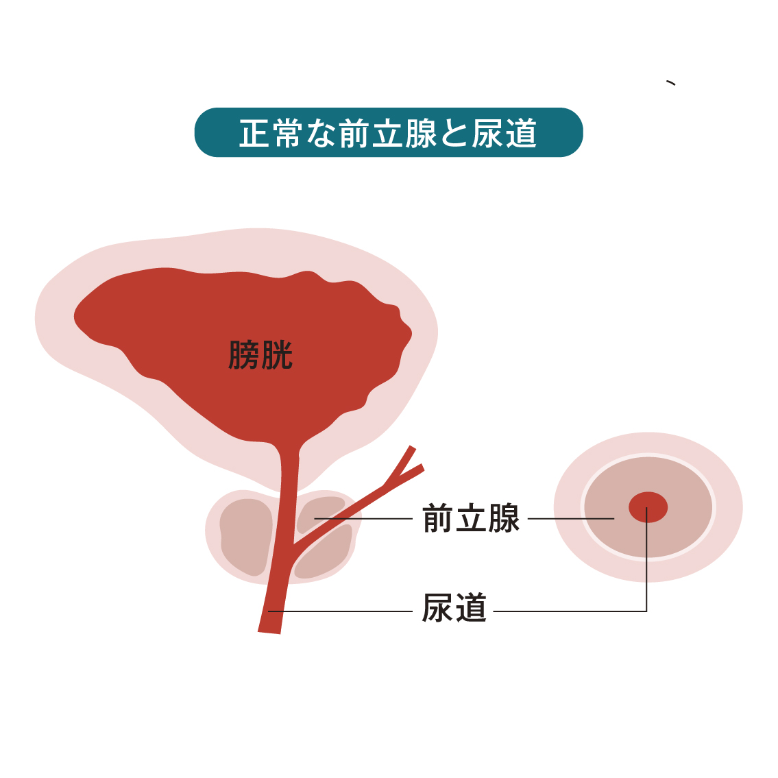 イメージ：正常な前立腺と尿道